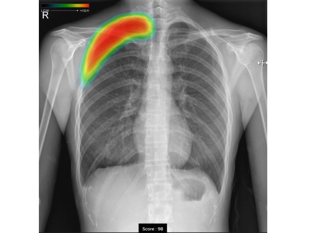 胸部レントゲンAI画像解析システム
